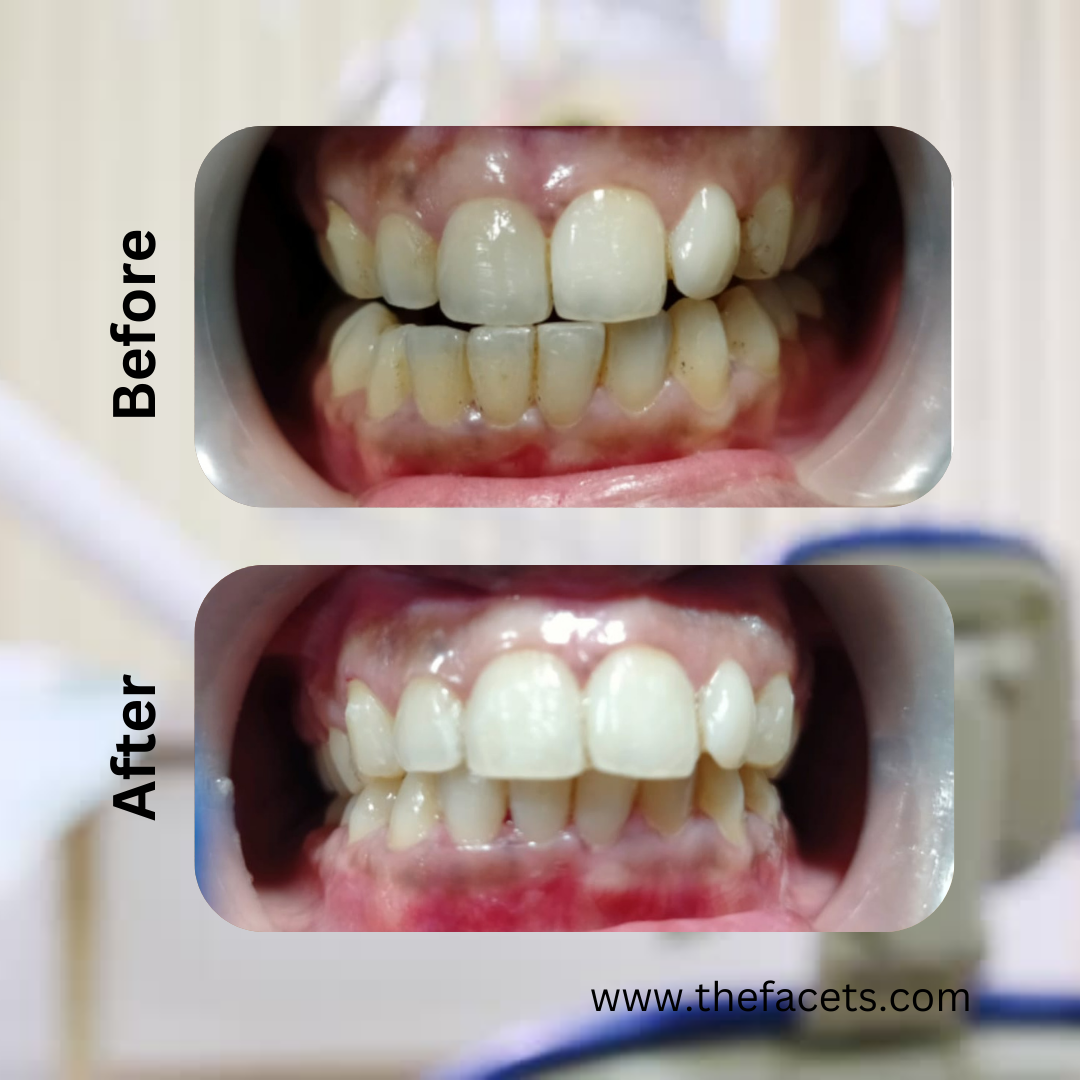 Before After 9